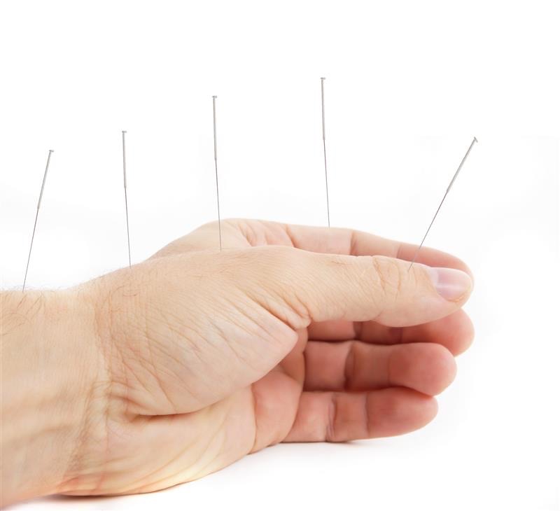 Nadelakupunktur auf einer Hand