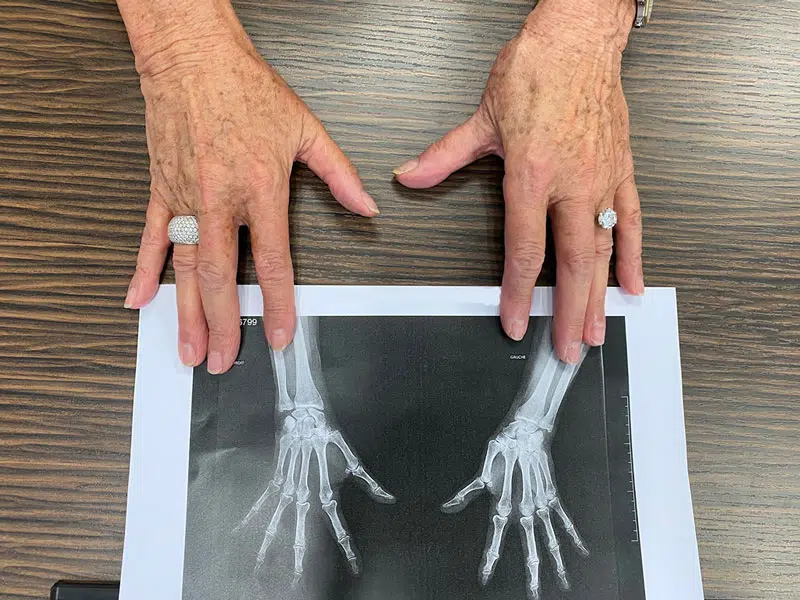 Mani sopra una radiografia delle mani.